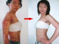 牛皮癣女性患者